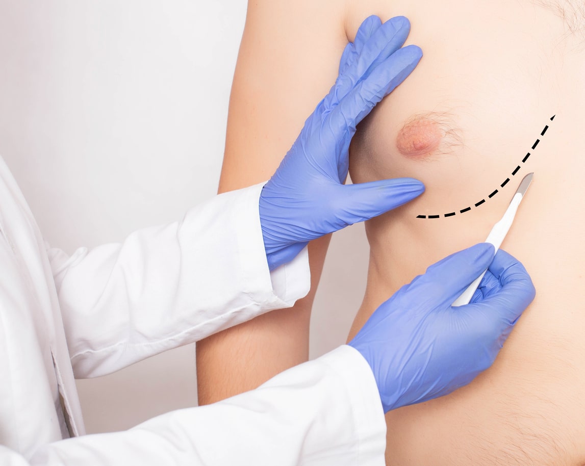 Doctor plastic surgeon with scalpel near male patient's chest. Male Breast and Nipple Reduction Concept, close up